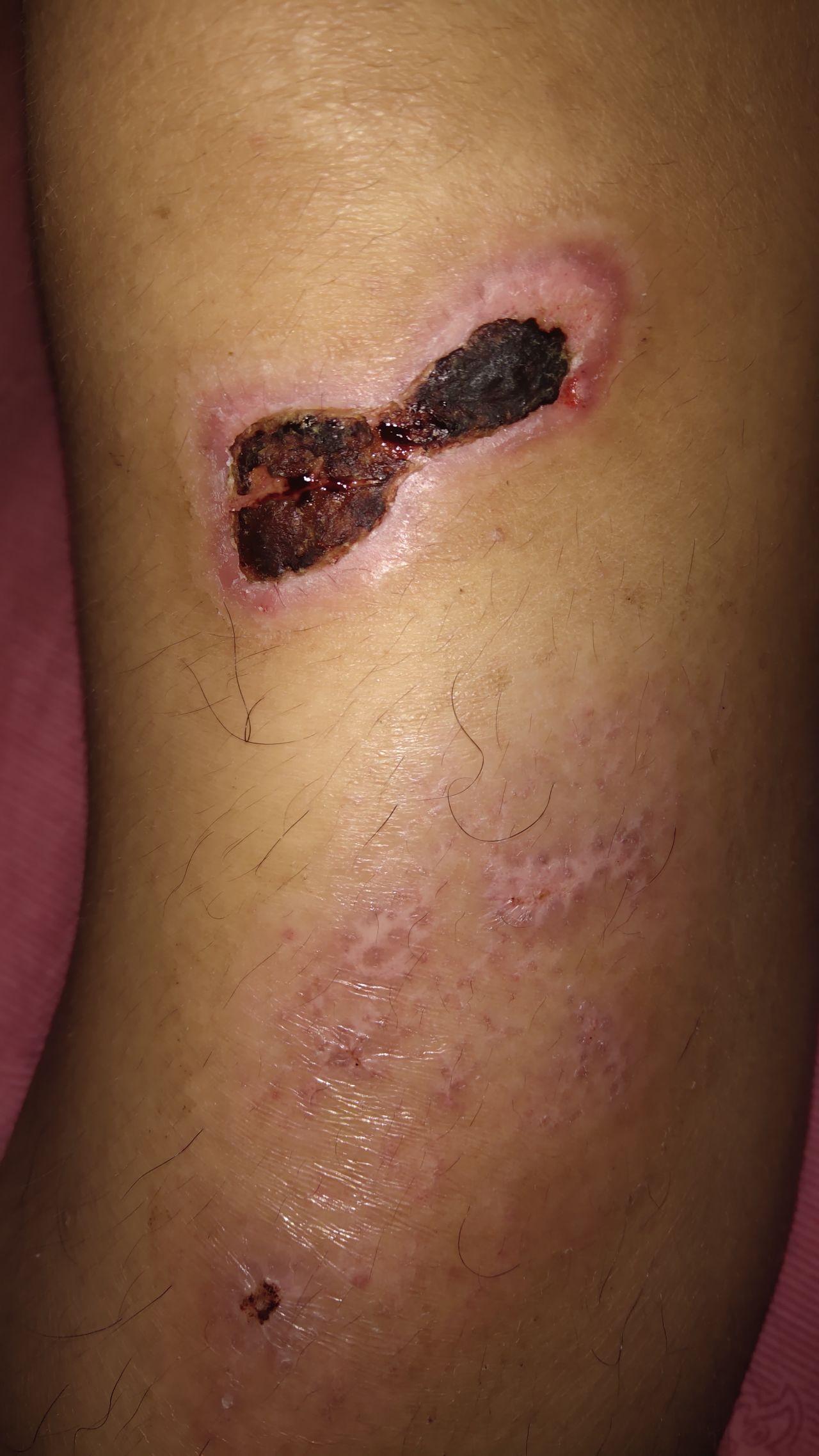 膝盖上的伤疤图片图片