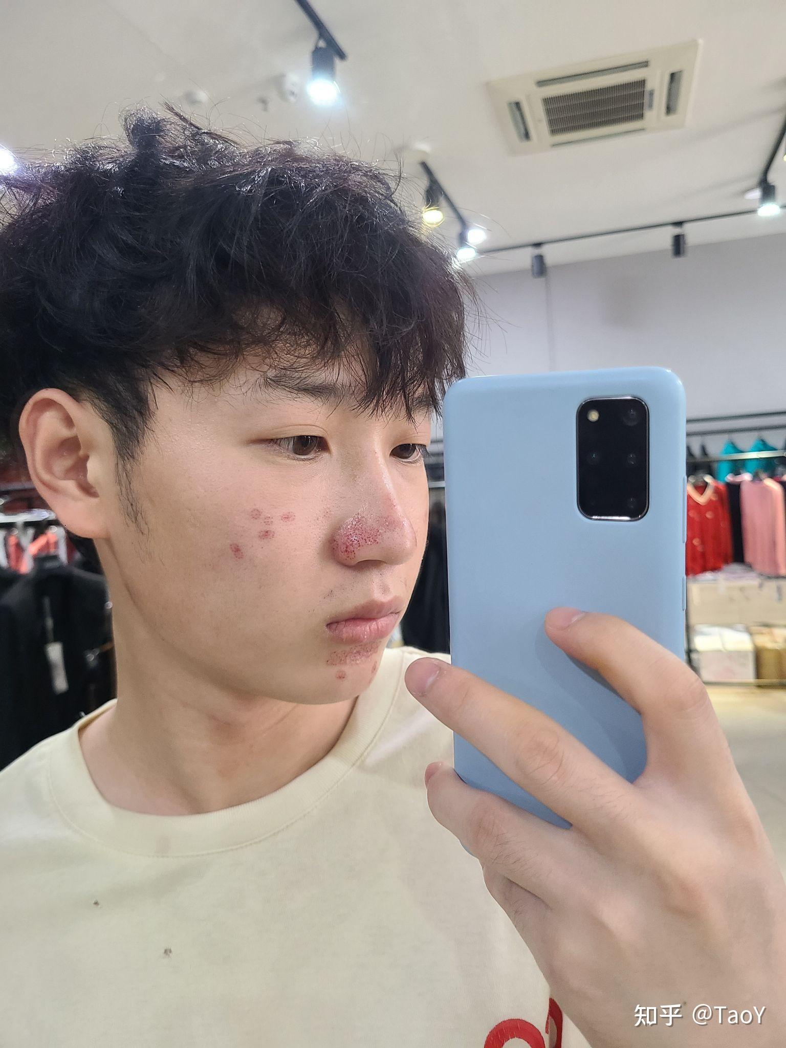 鼻子上凸起的增生痘疤怎么去除