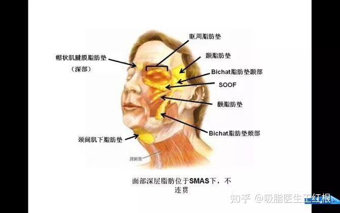 什么是颧脂肪垫?南韩整容模板一笑就崩的原因竟是这个! - 知乎