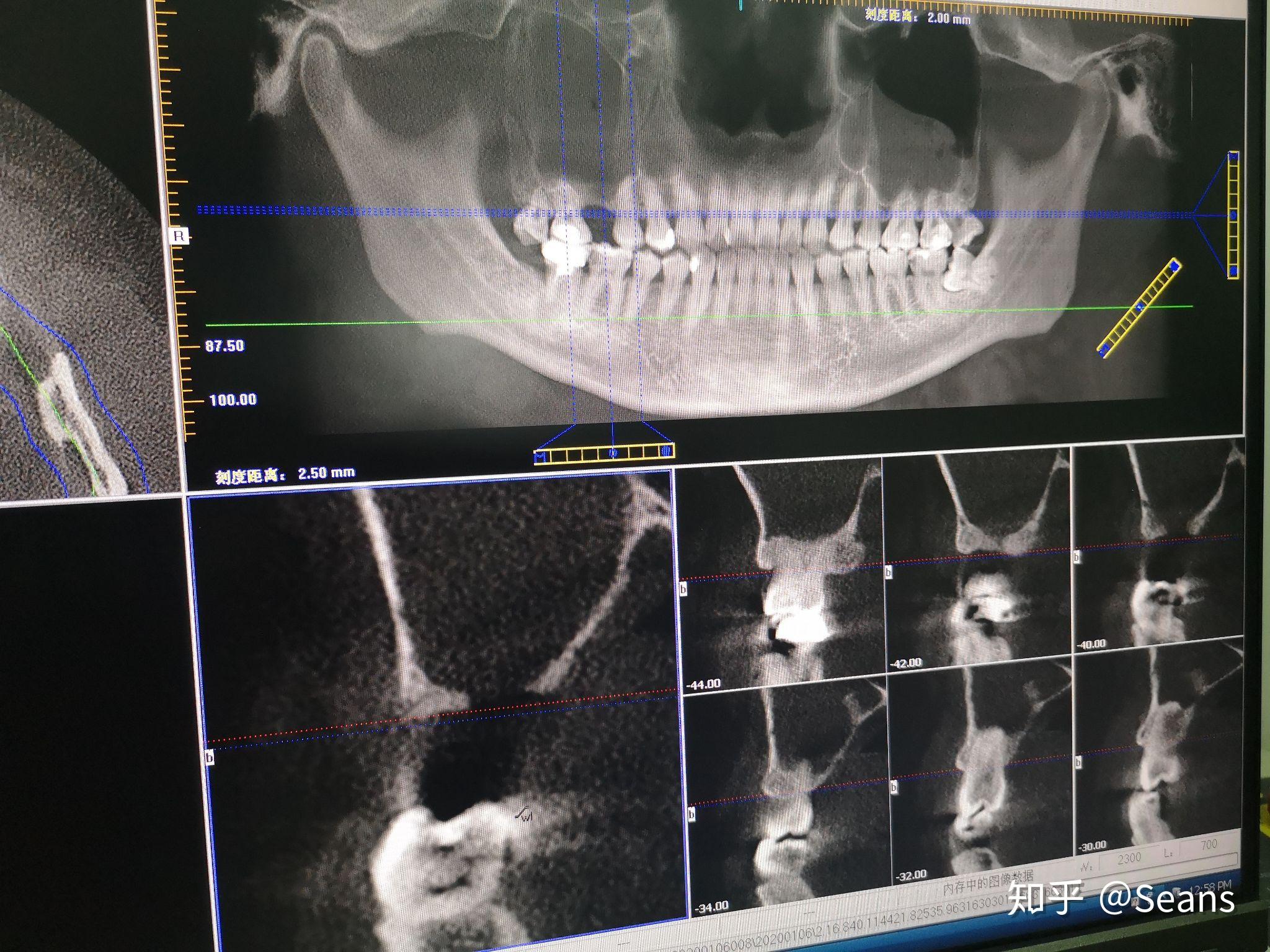 拔牙引起上颌窦穿孔是什么体验? - 知乎