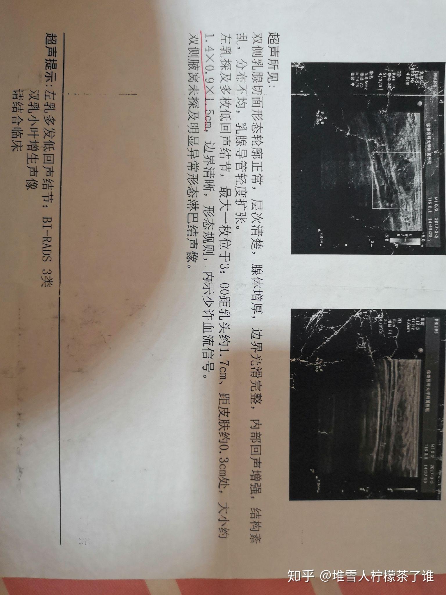 记录一下自己得乳腺纤维瘤的经历