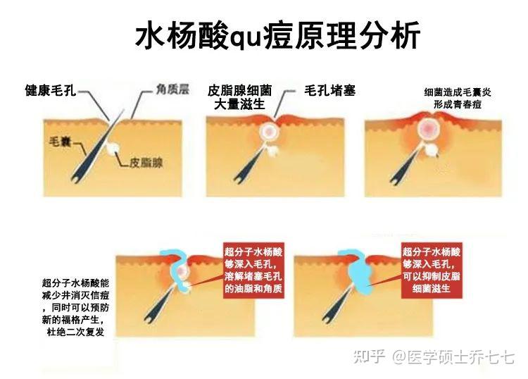 新手刷酸必看:超全刷酸教程!这两个刷酸步骤大多数新手都会忽略!!医学硕士教你如何正确刷酸!! - 知乎