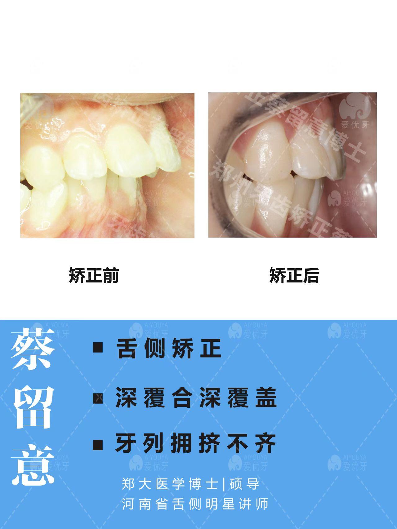 广州牙齿矫正（正畸）|近期，深覆合深覆盖合集