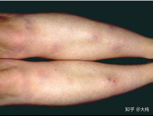结节病的症状是什么?