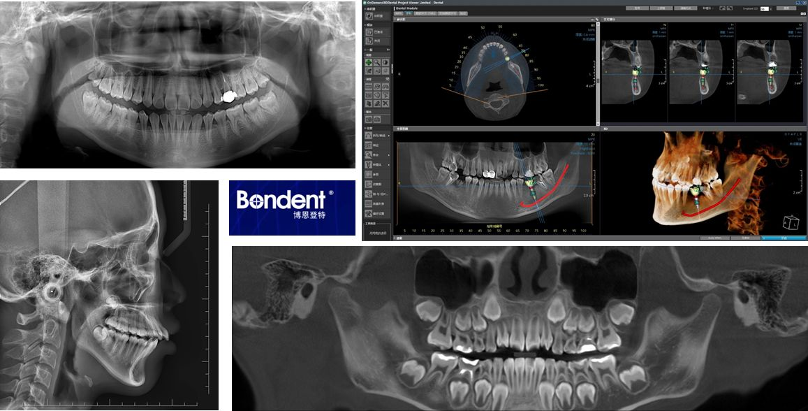 伯爵cbct影像篇⑧拍牙片辐射那些事儿