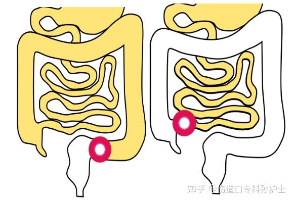 回肠造口位置图片