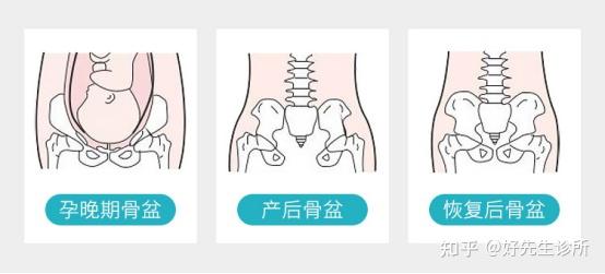 生完孩子後骨盆痠痛產後骨盆修復有必要做嗎