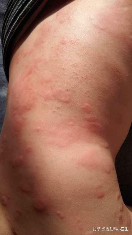 传染性软疣建议消毒后由消毒镊子夹破疣体,挤干净内容物,然后涂抹碘酊