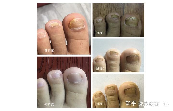 【甲菌|甲癣合集】看!这些灰指甲都好了!