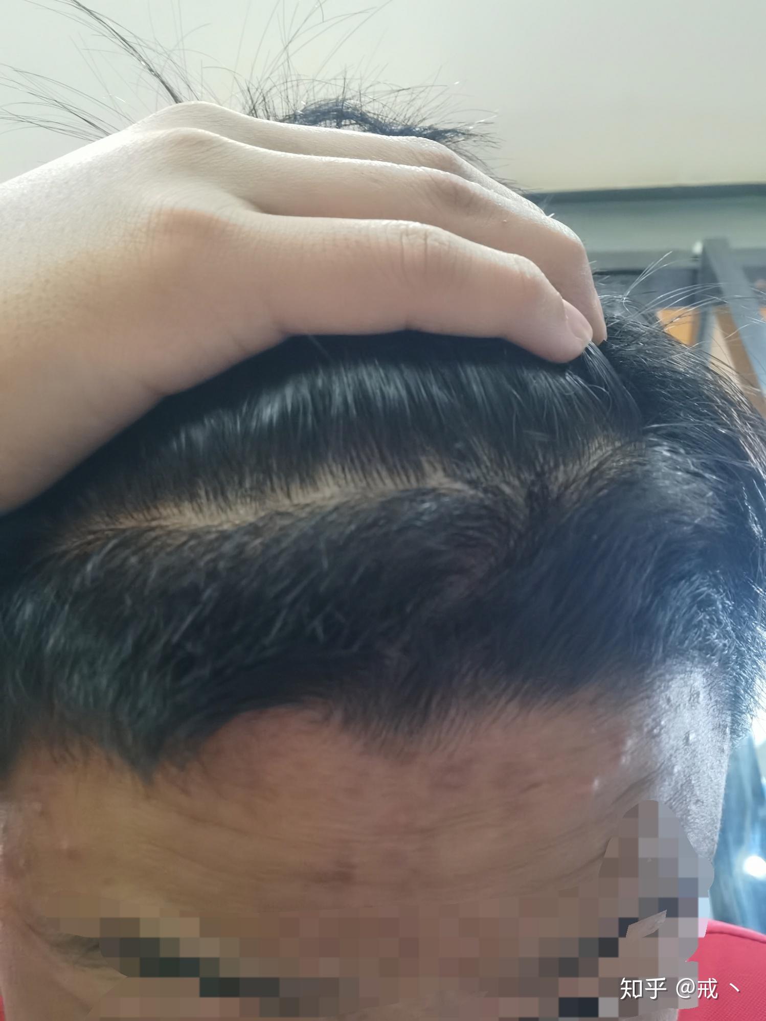 男生发际线有旋怎么办能设计什么发型吗