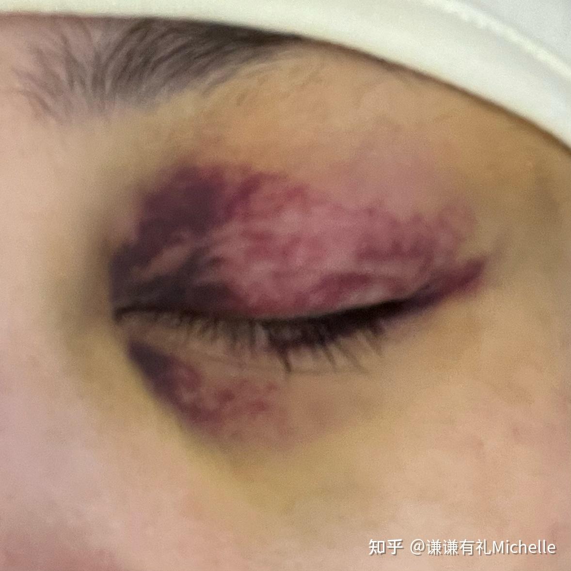 撞到了头,眼睛淤青严重怎么办?