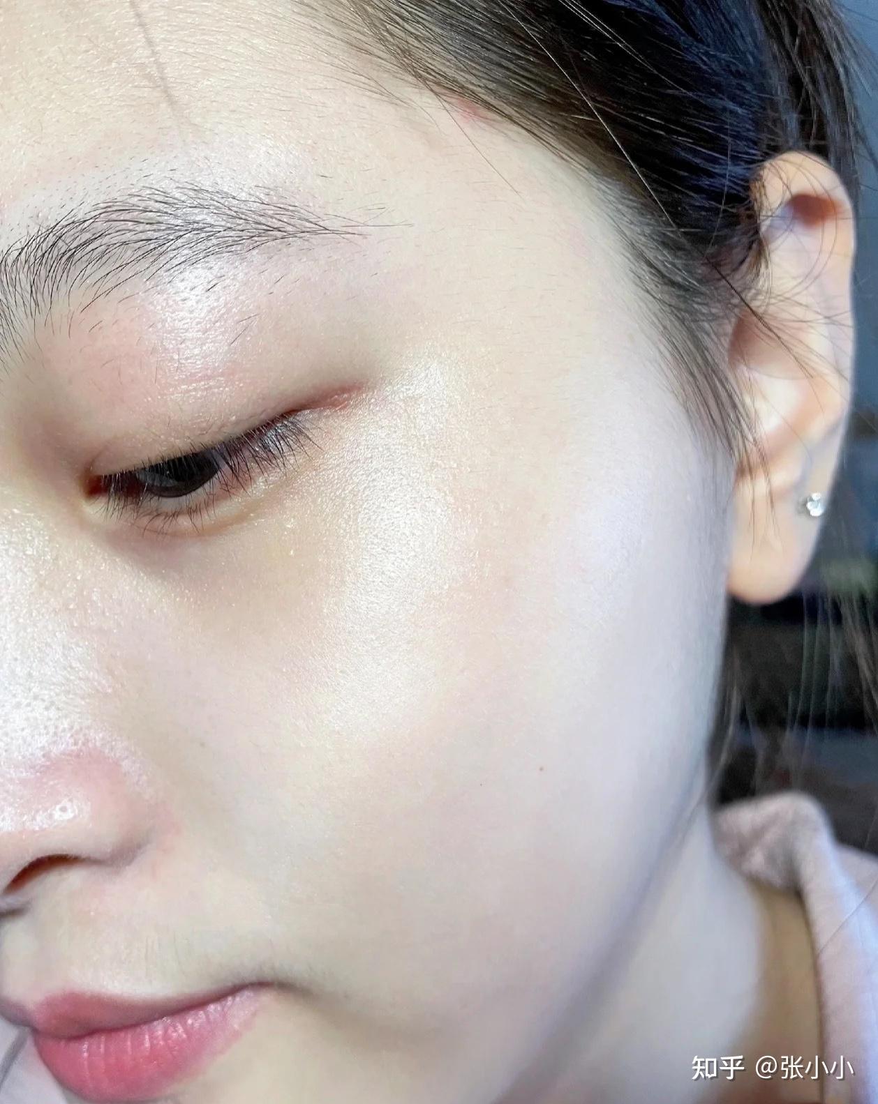 1.改善皮肤脆弱