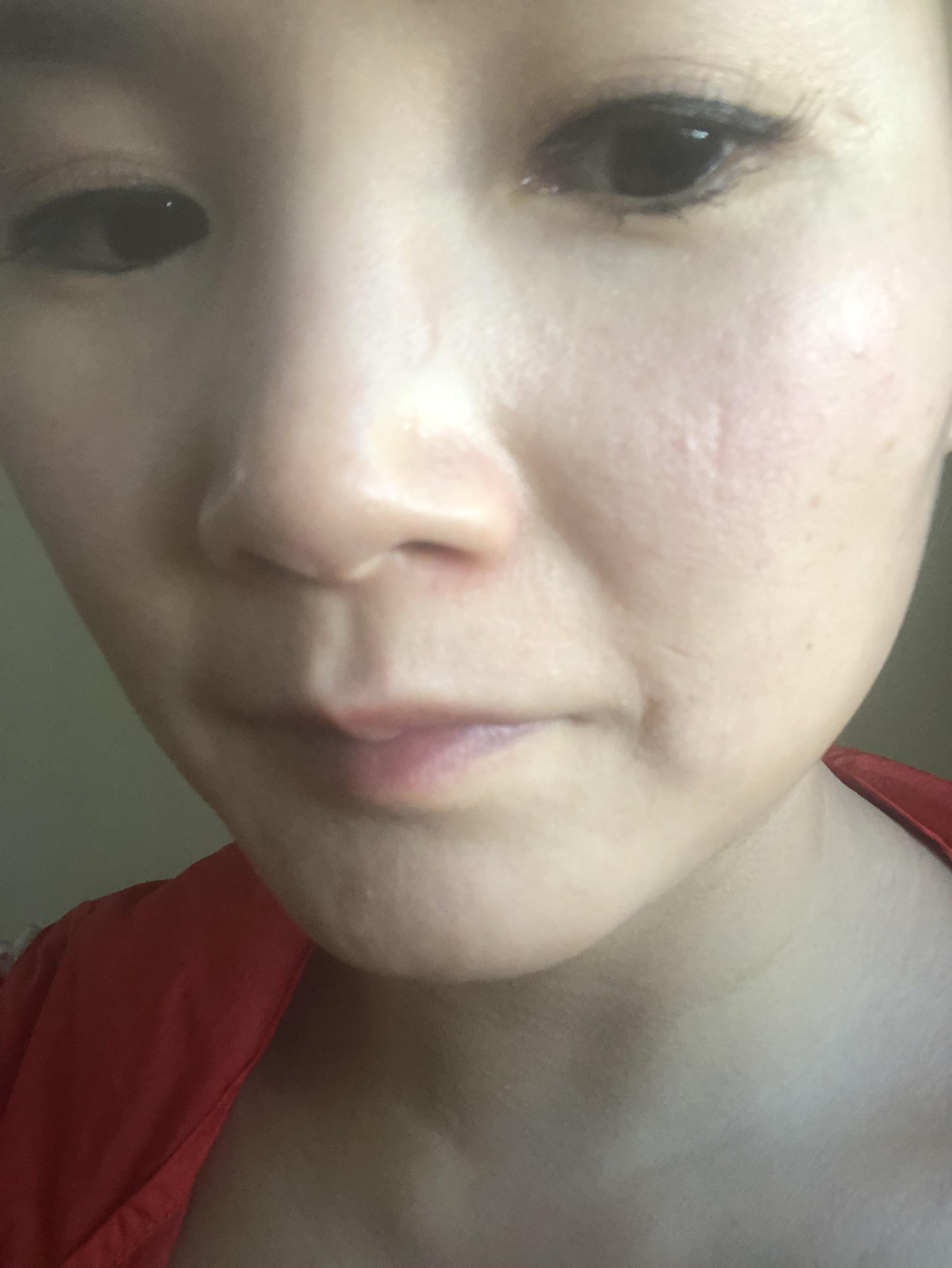 日光性皮炎日晒伤晒斑