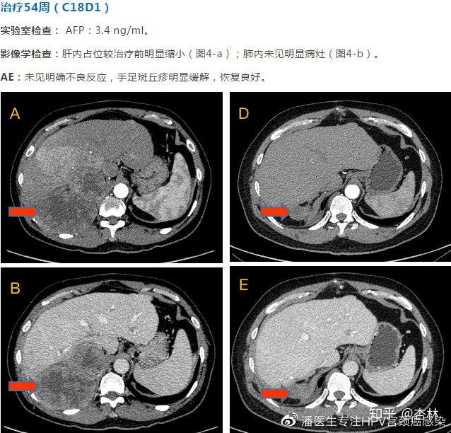 病例分享无进展生存期达14个月免疫治疗复发转移肝细胞癌一例