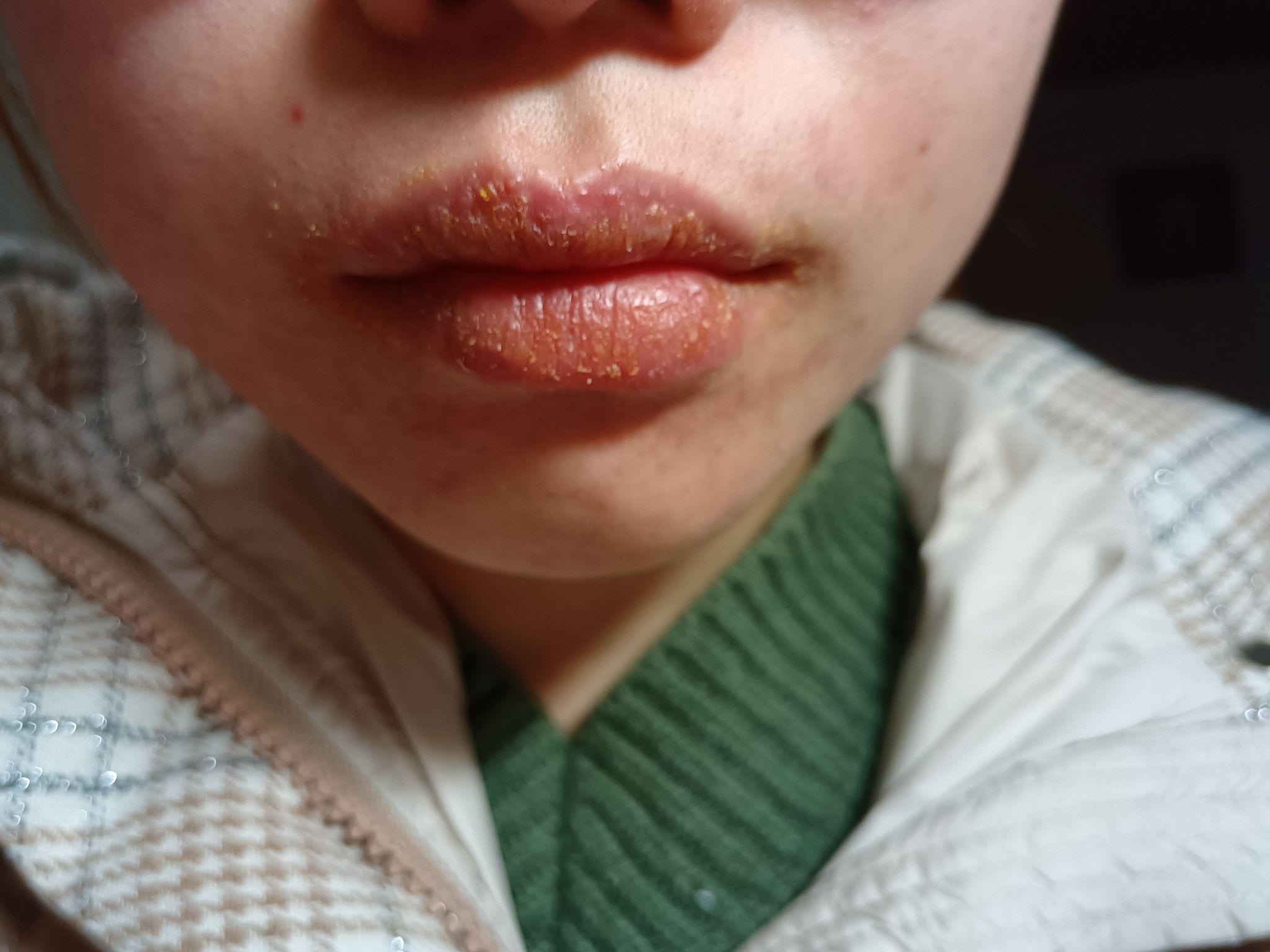 我还在和唇炎做间断性的斗争