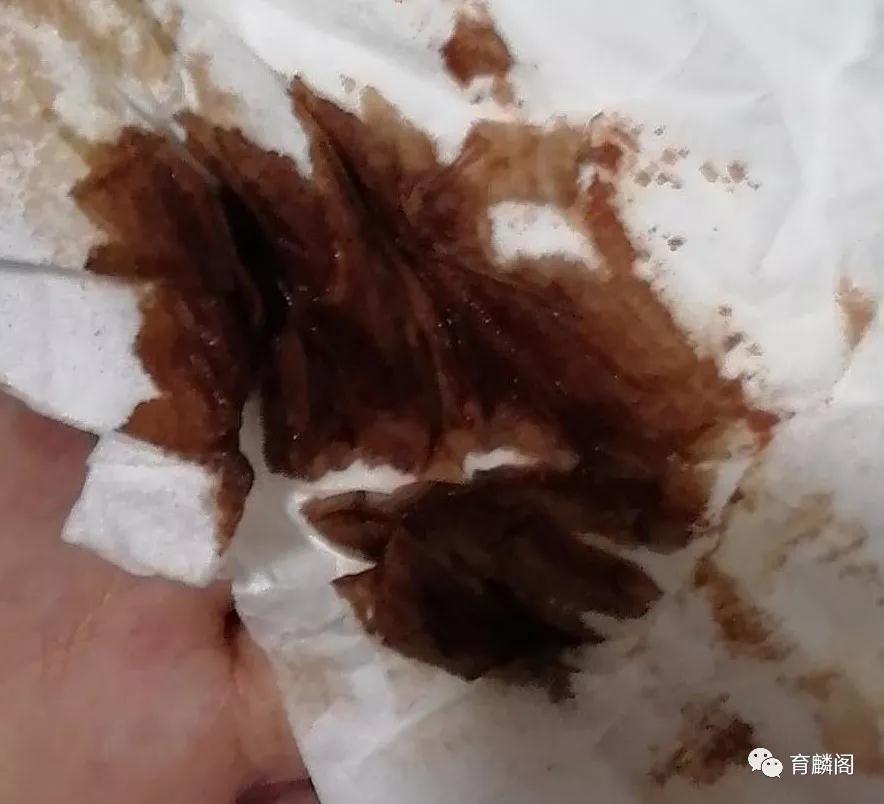 孕期血性分泌物我们该怎样对待