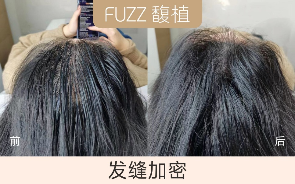 发缝宽怎么办?发缝大怎么改善? - 知乎