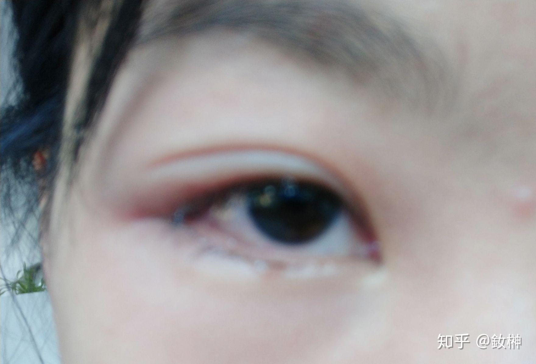 眼睑炎？下眼皮里面长了透明小泡 大概长了一两个月了。没有消退。不痛不痒，什么感觉也没有？ - 知乎