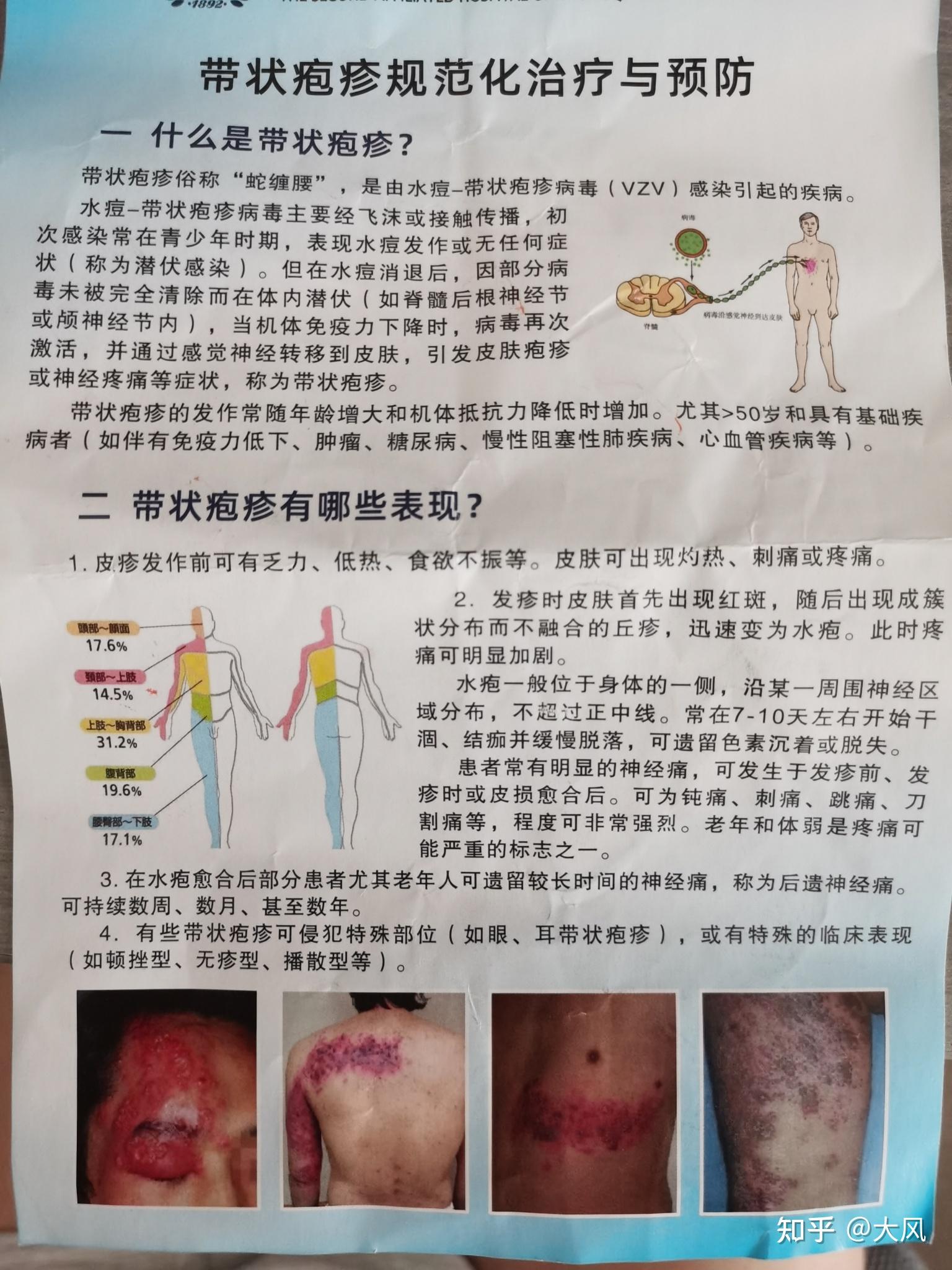 带状疱疹怎么治疗图片