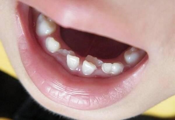 东莞松山湖怎样可以预防小朋友牙齿不齐呢?