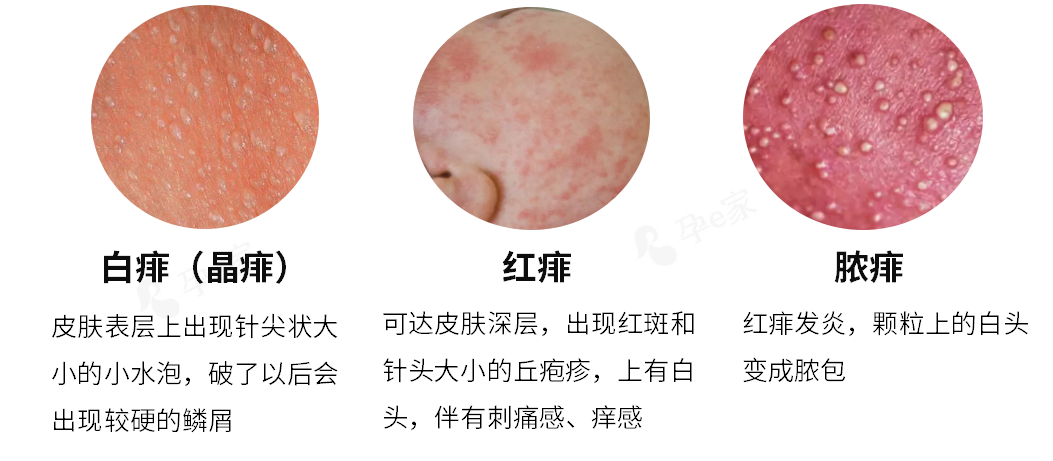 痱子、湿疹、淹脖子,1张图教你分清(附护理方法) - 知乎
