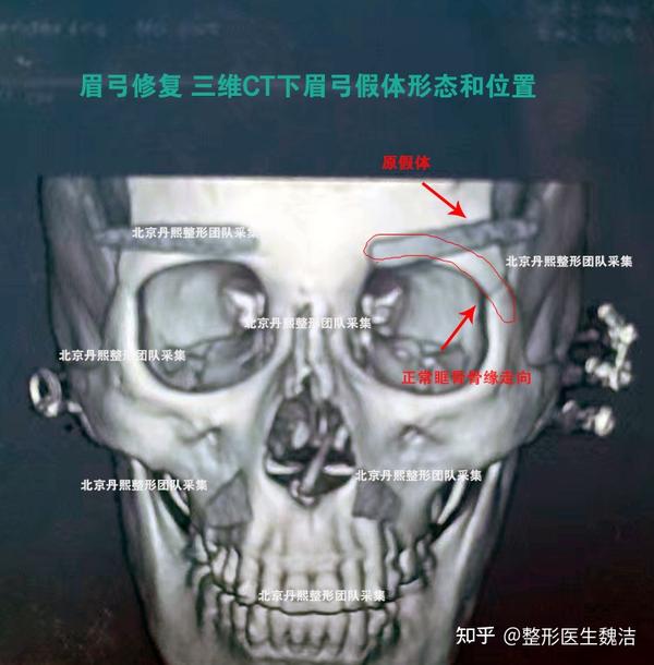 分析假体眉弓失败修复一例 三维成像CT下的眉弓 - 知乎