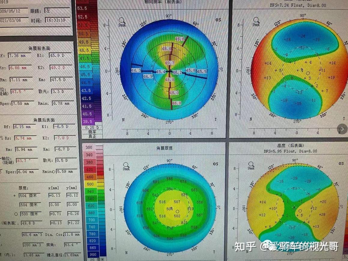 考慮患者角膜曲率較高散光較大建議做角膜地形圖排除圓錐角膜os -1.