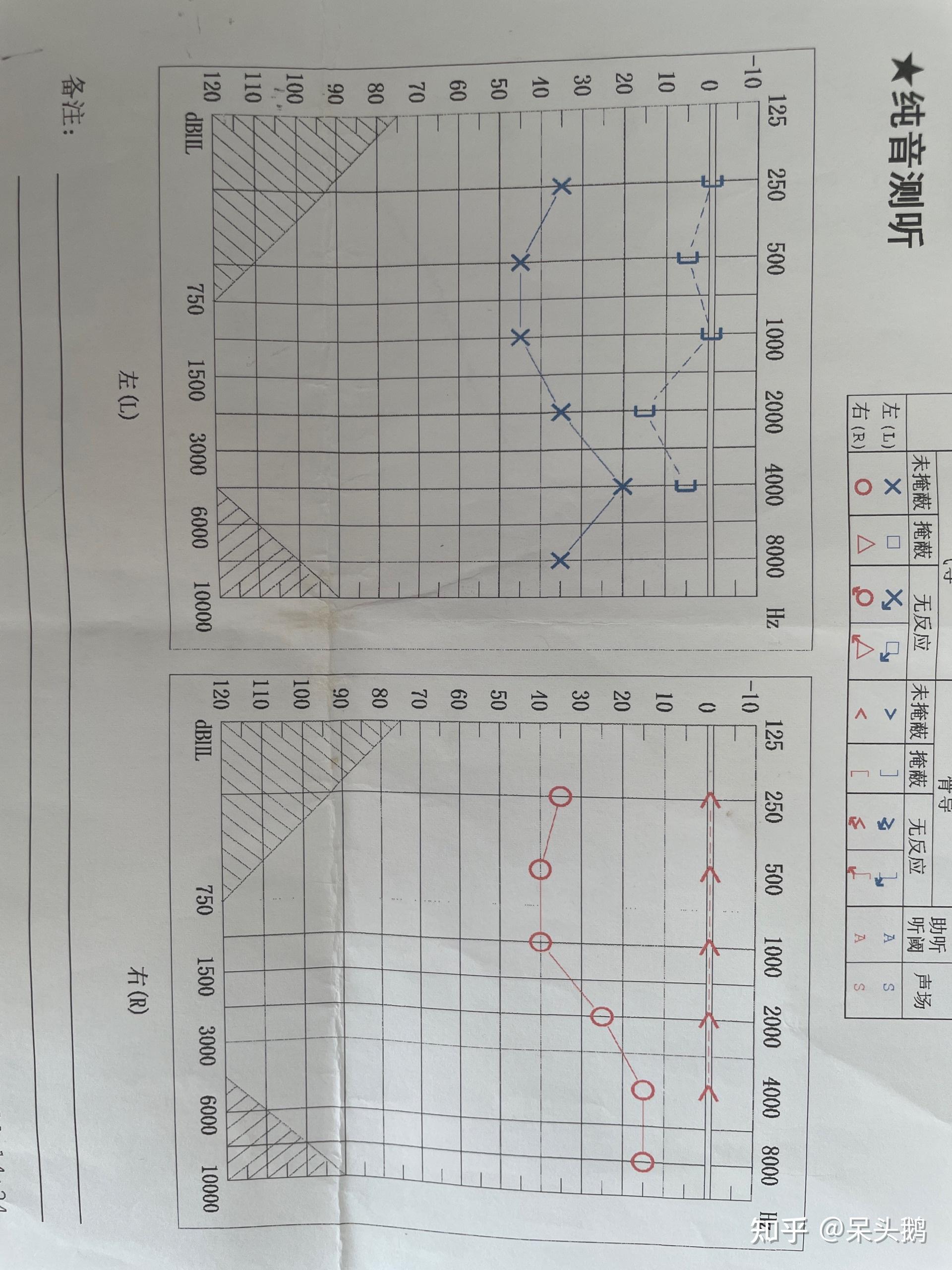 电测听正常图图片