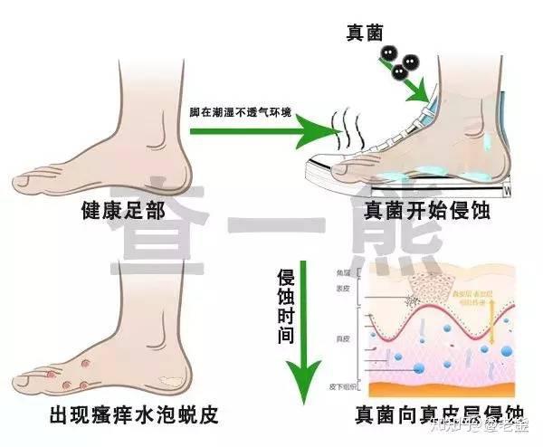 科普 足部皮肤最大的危害 脚气 知乎