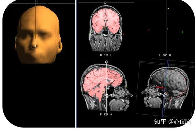 经颅磁刺激常用定位方法