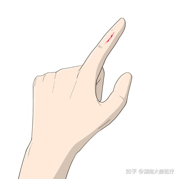 日常生活常见小伤口处理 - 知乎
