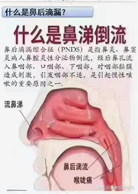 患鼻炎的你知道什么是鼻涕倒流不