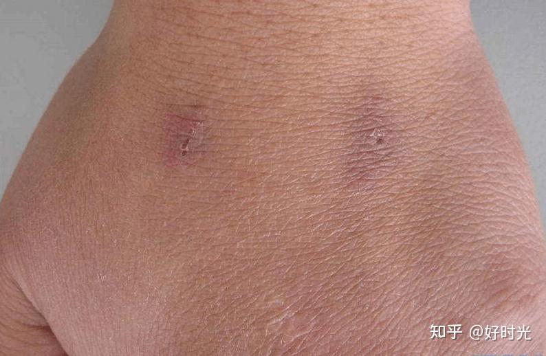 根据以上介绍认为,在检测方面,针刺反应更有意义,是现在仅有特异性强