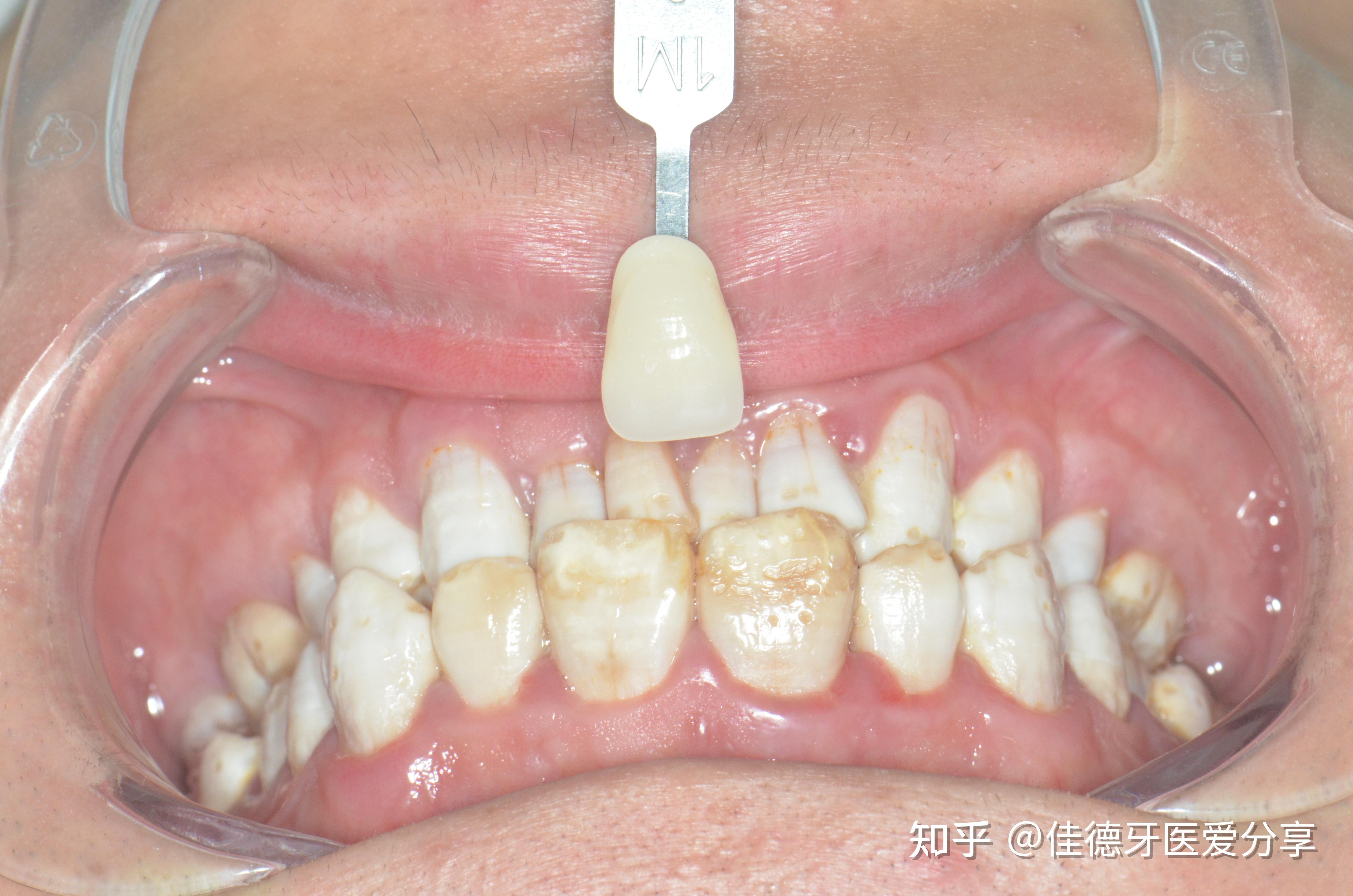 【病例分享】渗透树脂治疗氟斑牙前牙一例-搜狐大视野-搜狐新闻