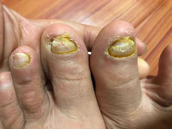 灰指甲不要怕跟着我3个月让你恢复健康指甲