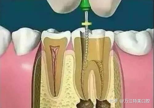 根管治疗步骤图解,让你清晰了解根管治疗整个过程! - 知乎