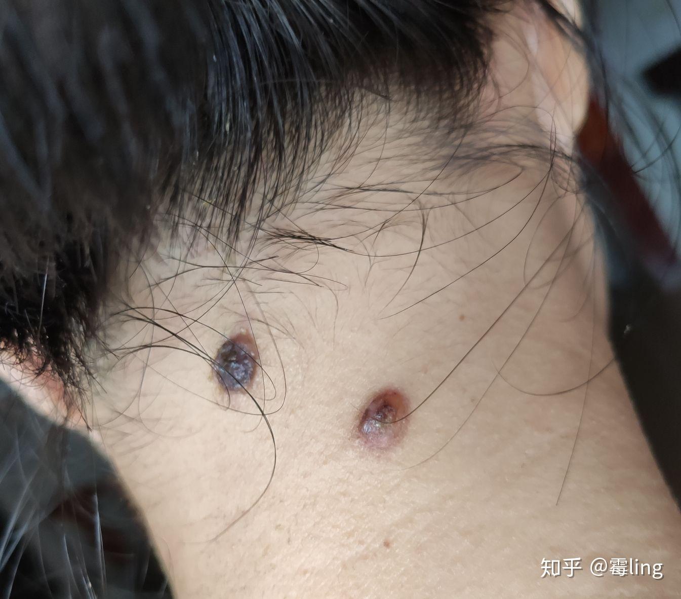 我来记录一下冷氮点痣的过程!