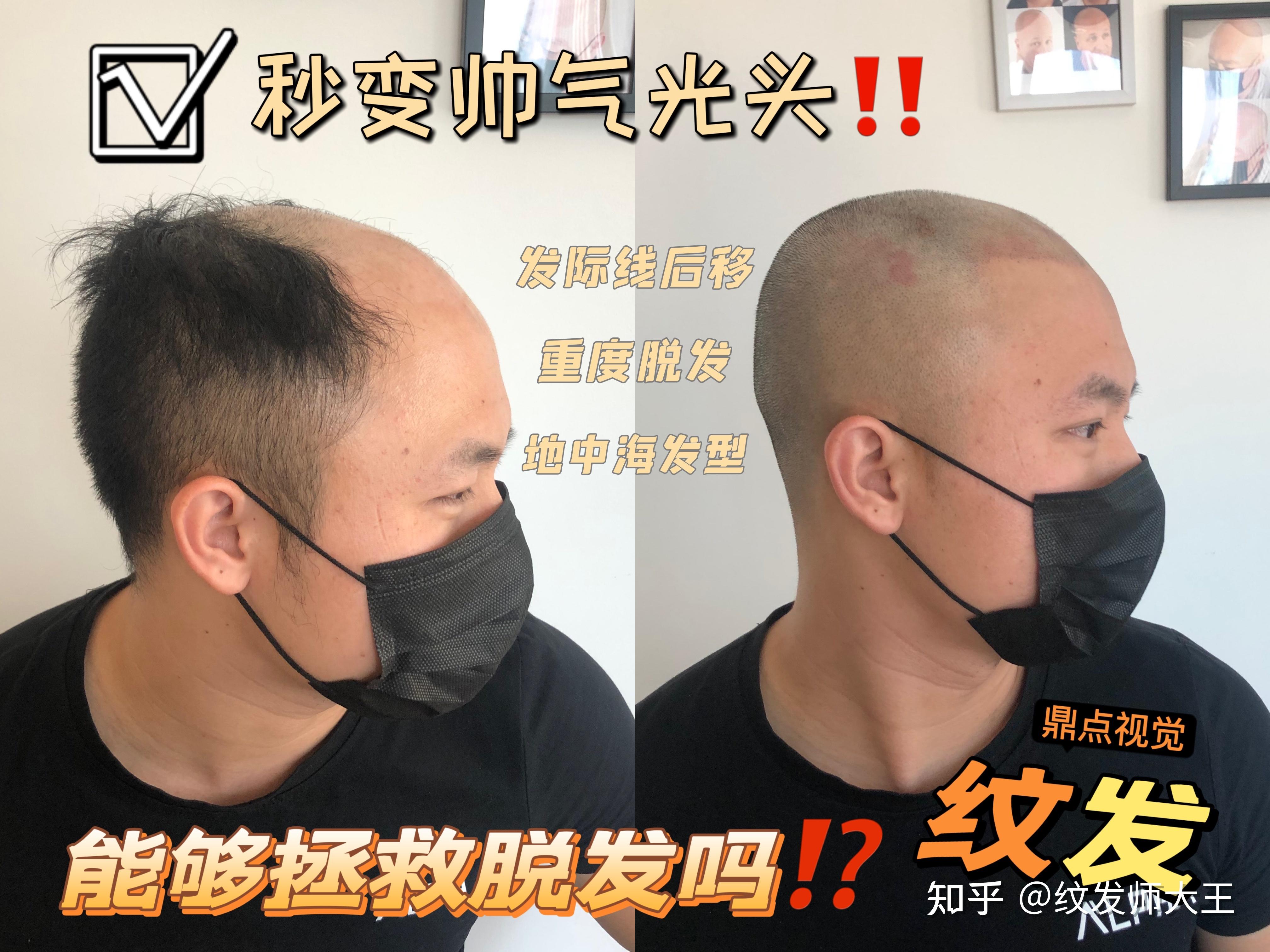 光头和秃顶的区别在哪里⁉️不脱发的你不一定明白🔅 - 知乎