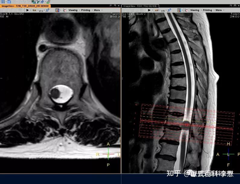 磁共振脊柱规范扫描及技术应用(胸椎部分) - 知乎