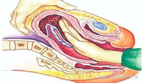科男医生徒手掏胎盘,大多产妇最遭罪的经历