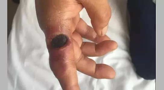 突发北京山西出现炭疽病与新冠同级会人传人吗要隔离吗牛羊肉还能食用