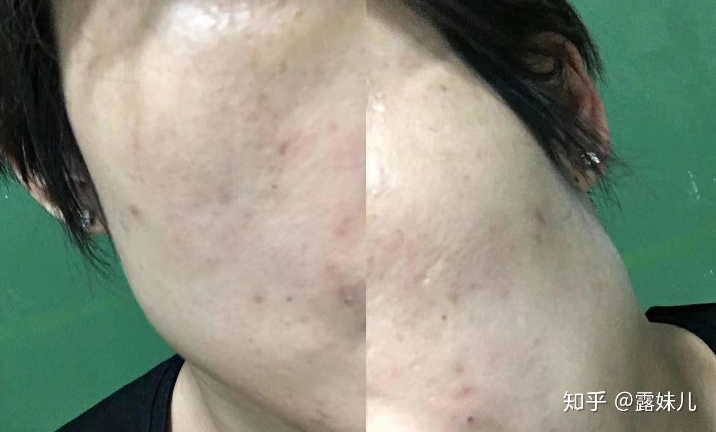 我经常用碘伏抹痘痘床上也有很多碘渍请问这么长期会让我碘中毒吗或者