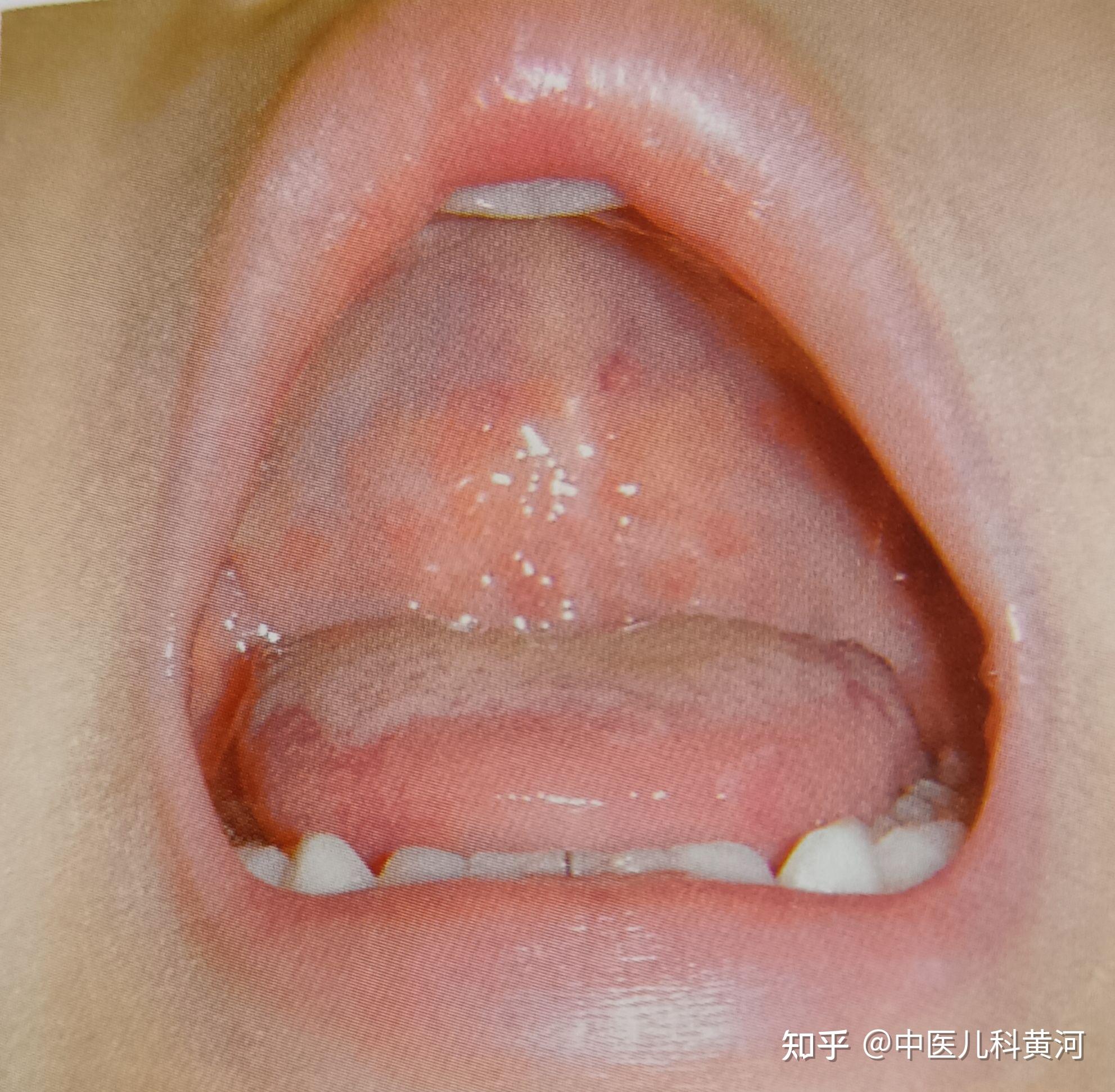 以上,可因咽痛及口腔疱疹疼痛明显而出现流口水,拒食,呕吐,头痛等症状