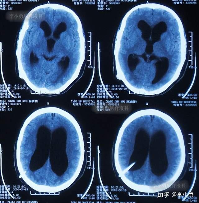 进行了头颅mri和头颅ct示脑室扩张,脑积水