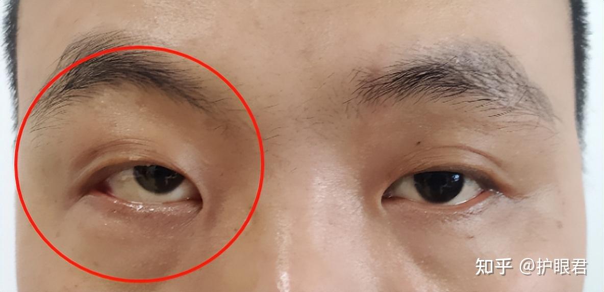 猫眼、眼突、黑痣……眼睛出现这些情况要小心了，可能是肿瘤！ - 知乎