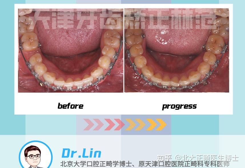 鄭州隱適美認證醫師林範隱適美模擬方案調整咬合排齊牙齒擴弓和推磨牙