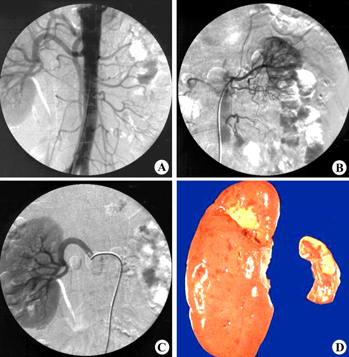 右肾影缩小,呈分叶状图6-45:右肾萎缩,左侧肾盂输尿管积水ctct平扫(a