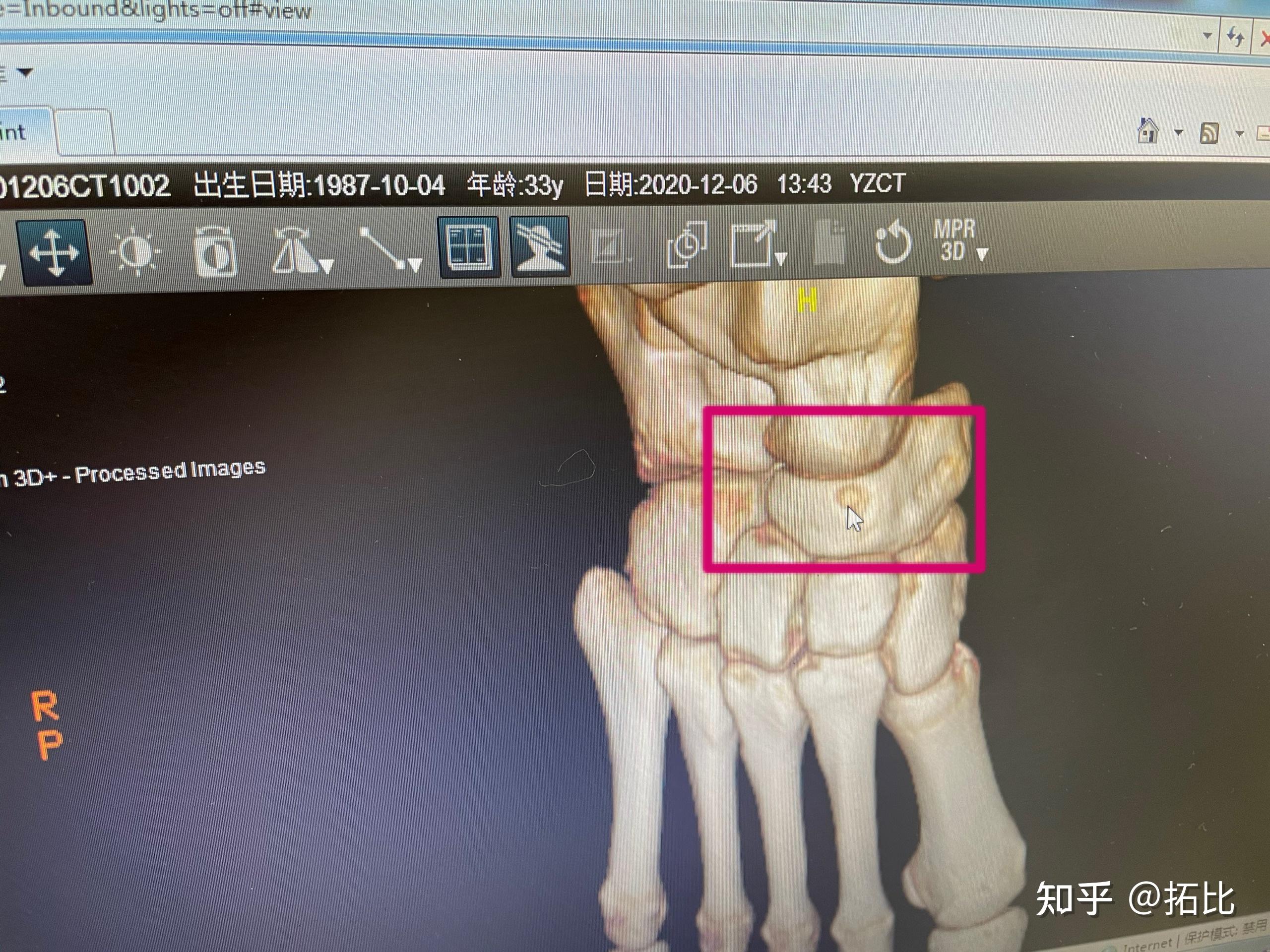 报告居然说我是右脚足舟骨前背面和足根骨前外缘撕脱性骨折,有小片
