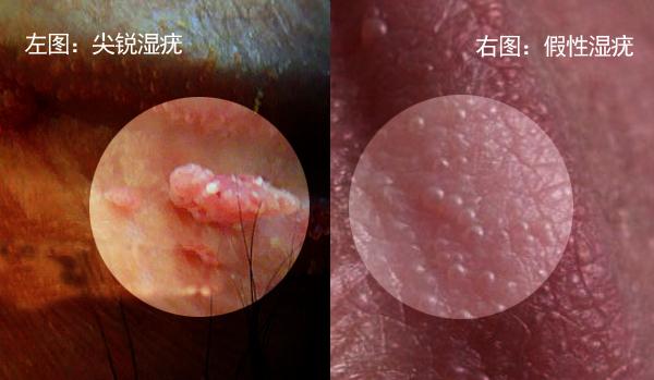 女性尖锐湿疣