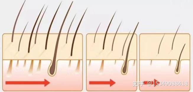 毛发种植效果怎么样,毛发种植效果图对比惊呆了~ - 知乎